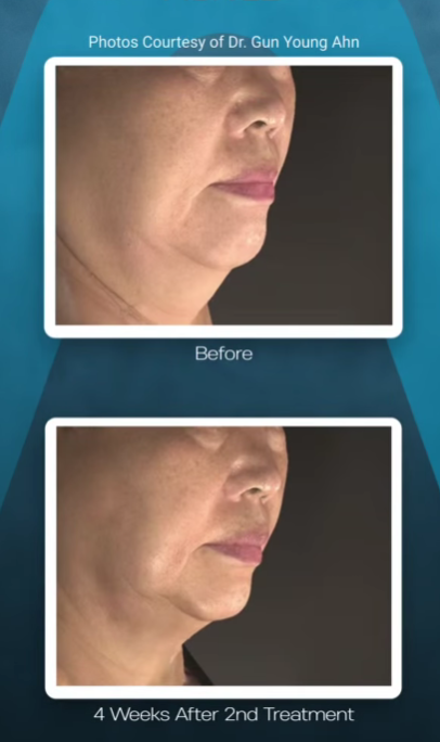 Before and after comparison of a person's jawline, showing the results of a cosmetic skin treatment.