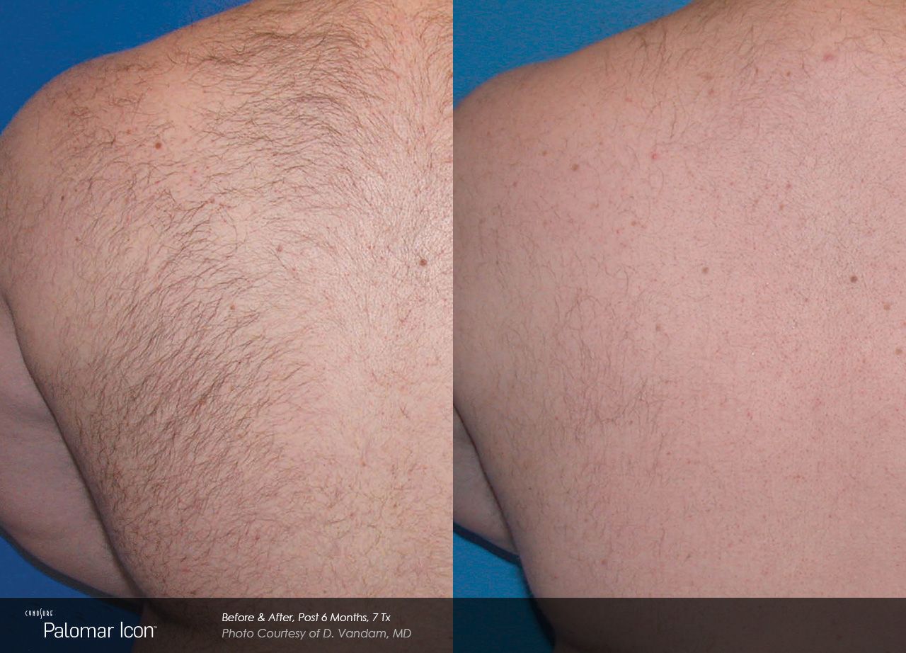 A before and after comparison of a human back, showing a significant reduction in hair after a laser treatment.
