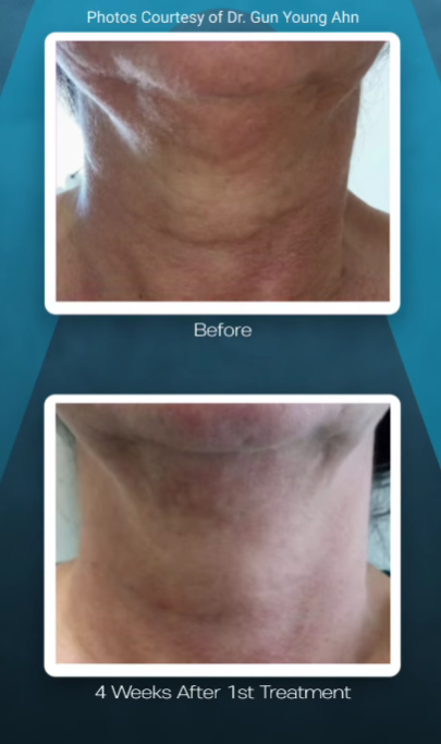 Before-and-after comparison of a neck area showing reduced skin laxity four weeks after a cosmetic treatment.