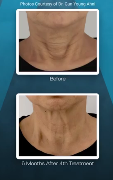 Before and after comparison of a person's neck after four skin treatments, showing a reduction in horizontal neck lines.