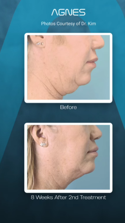 Before and after photos showing reduced submental fat and tightened skin on the jawline after two AGNES treatments.