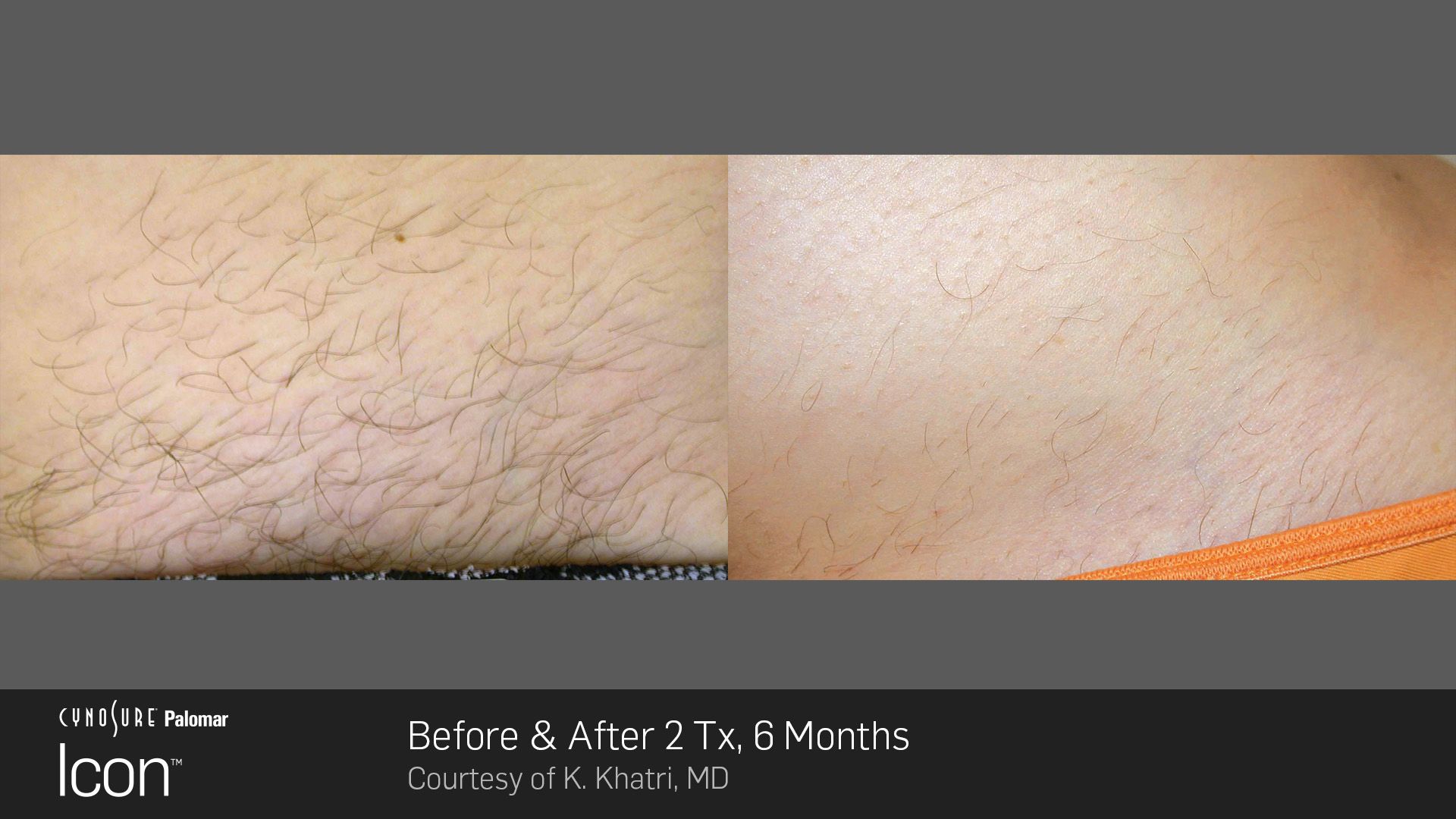Before and after comparison of laser hair removal on skin, showing significant hair reduction after two treatments.