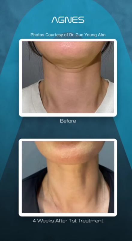 Before-and-after comparison of a neck area, showing results 4 weeks after an Agnes treatment.