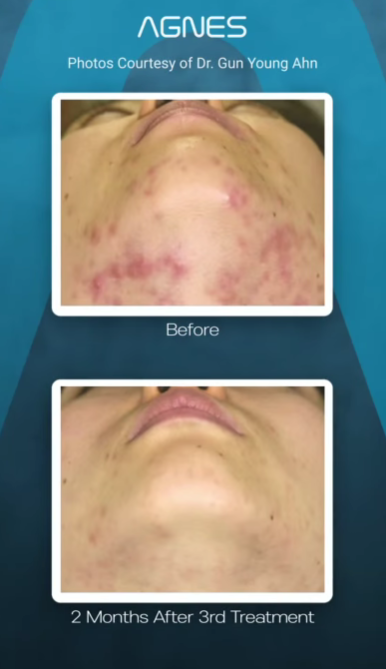 Before and after photos showing significant reduction in chin acne after three treatments with Agnes radiofrequency.