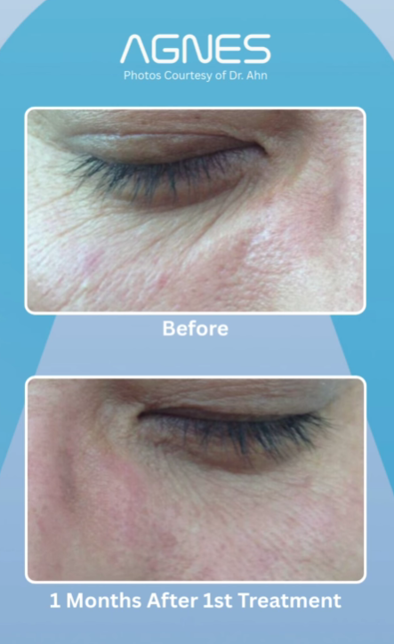 Before and after comparison of skin texture and wrinkles around an eye, one month after an Agnes cosmetic treatment.