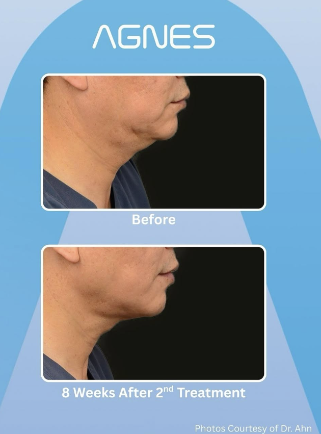 Before and after profile views showing reduction of submental fat after two AGNES skin treatment sessions.