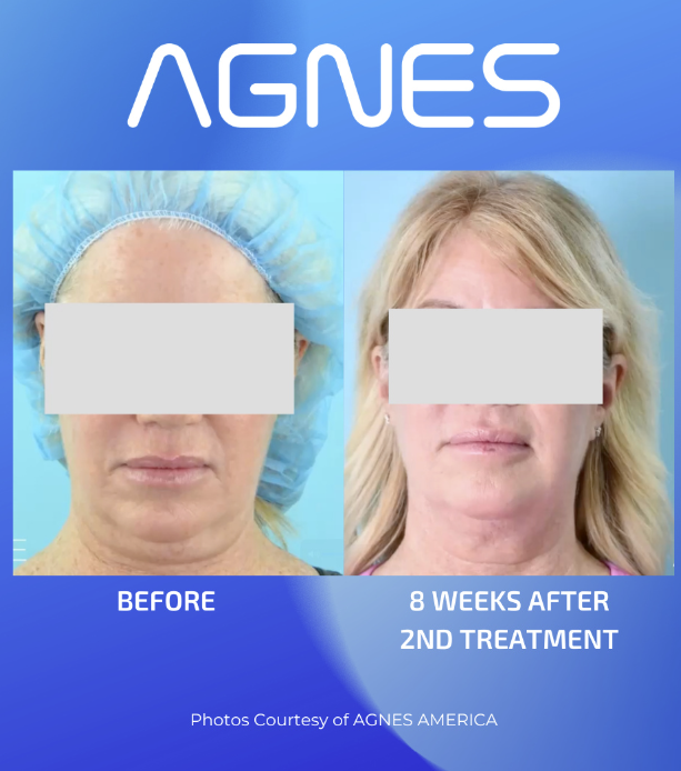 Before and after photos of a person's neck and chin, showing skin tightening results 8 weeks after two AGNES treatments.