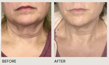 Before and after comparison showing a reduction in neck skin laxity and wrinkles after a cosmetic treatment.