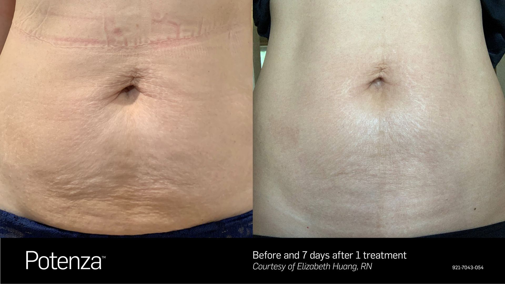 Before-and-after comparison of a person's abdomen showing skin tightening results after a Potenza treatment.
