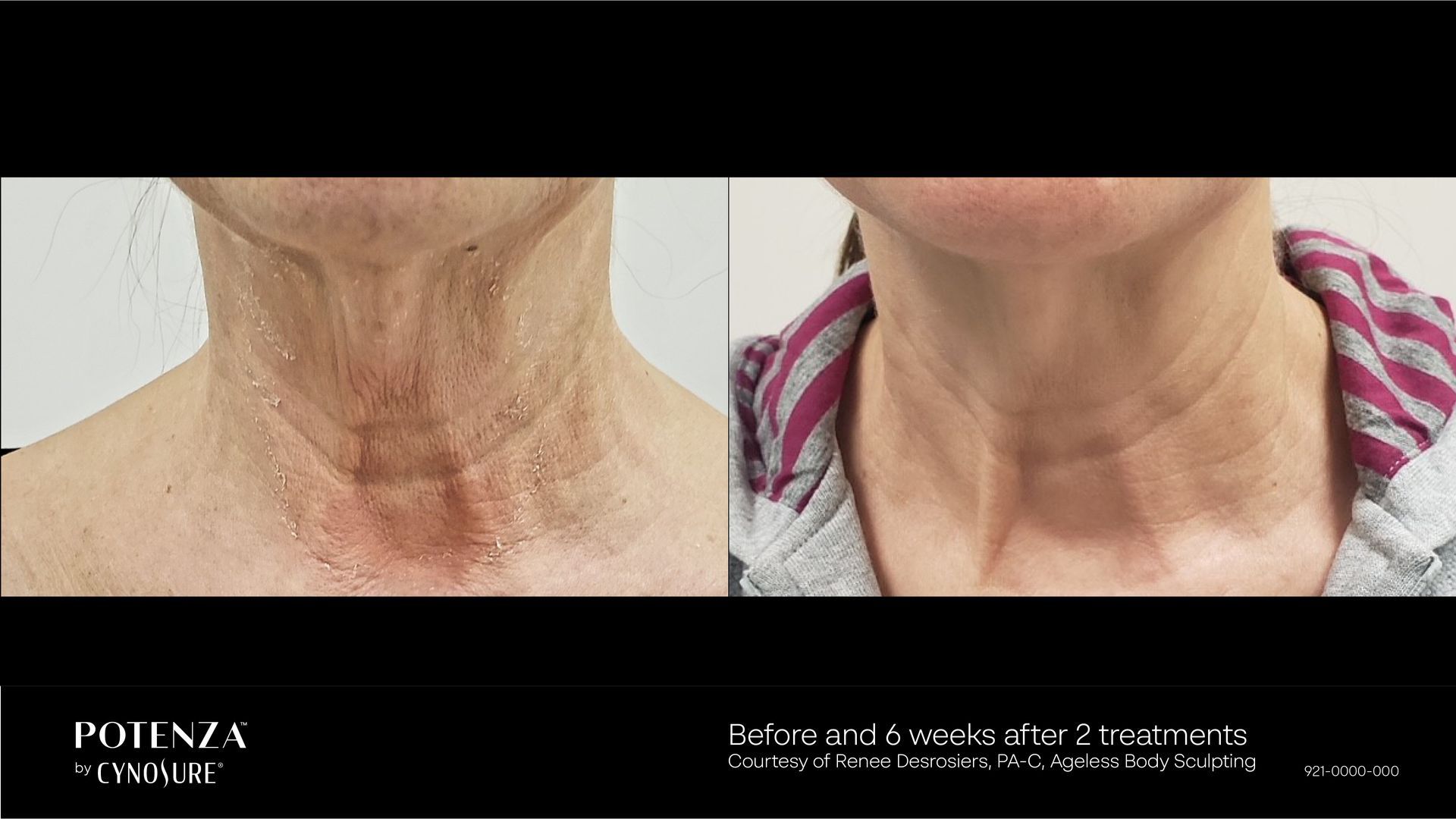 Before and after photos of a person's neck showing reduced wrinkles and improved skin texture after cosmetic treatment.