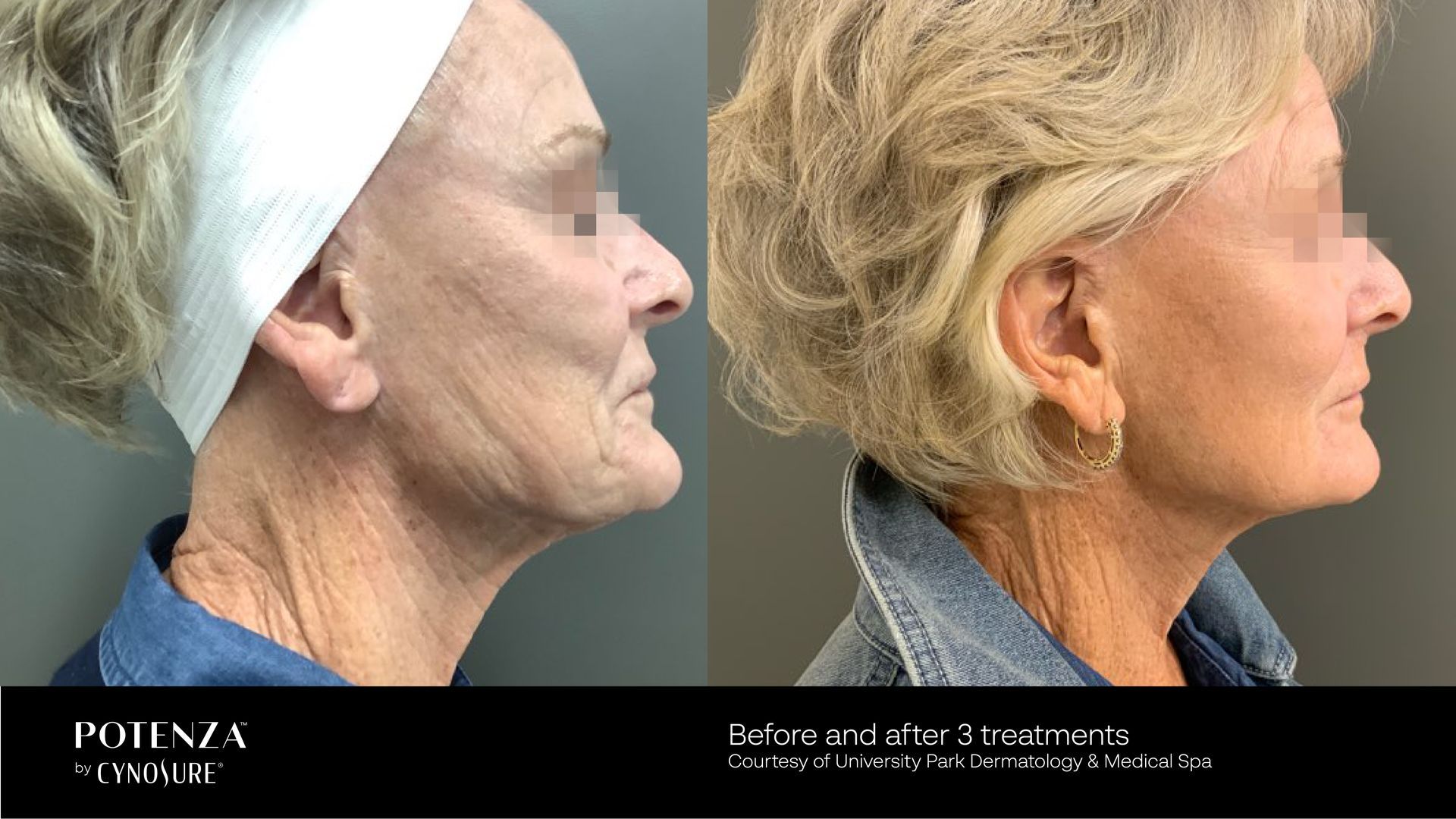Before and after comparison of a profile view showing skin texture improvement after a cosmetic treatment.