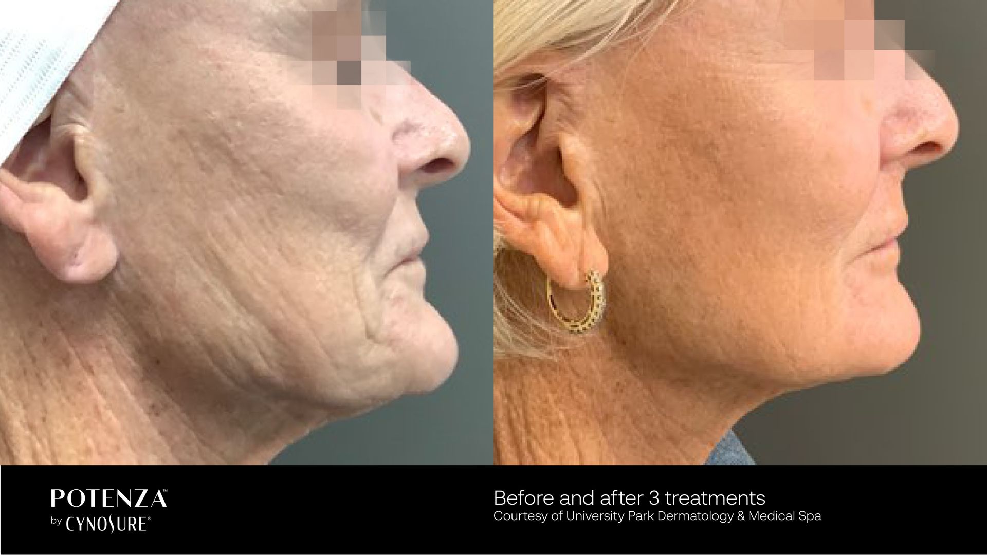 Before and after comparison of a person's facial skin texture and jawline firmness after a Potenza treatment.