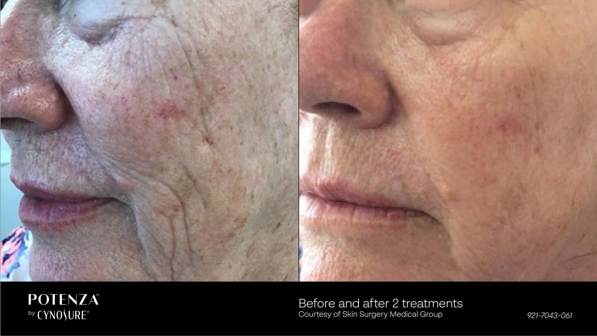 Before and after comparison of skin texture and wrinkles on a face, demonstrating the results of two Potenza treatments.