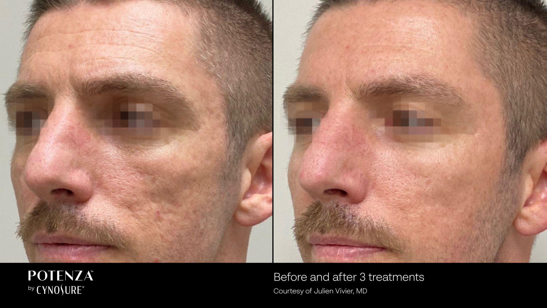 Before and after photos of a man’s cheek showing skin texture improvement after Potenza microneedling treatments.