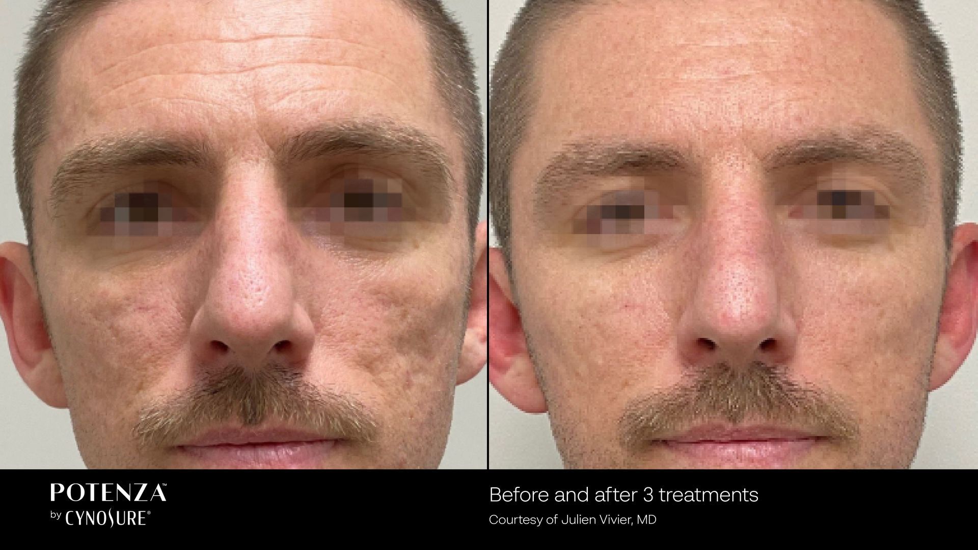 Before and after comparison of a person's face showing skin texture improvement after Potenza microneedling treatments.