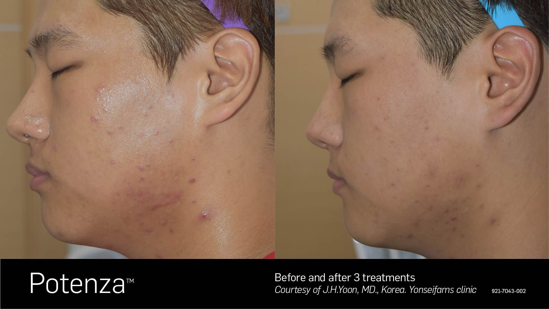 Before and after comparison of a person's cheek showing reduced acne and skin texture after two Potenza treatments.