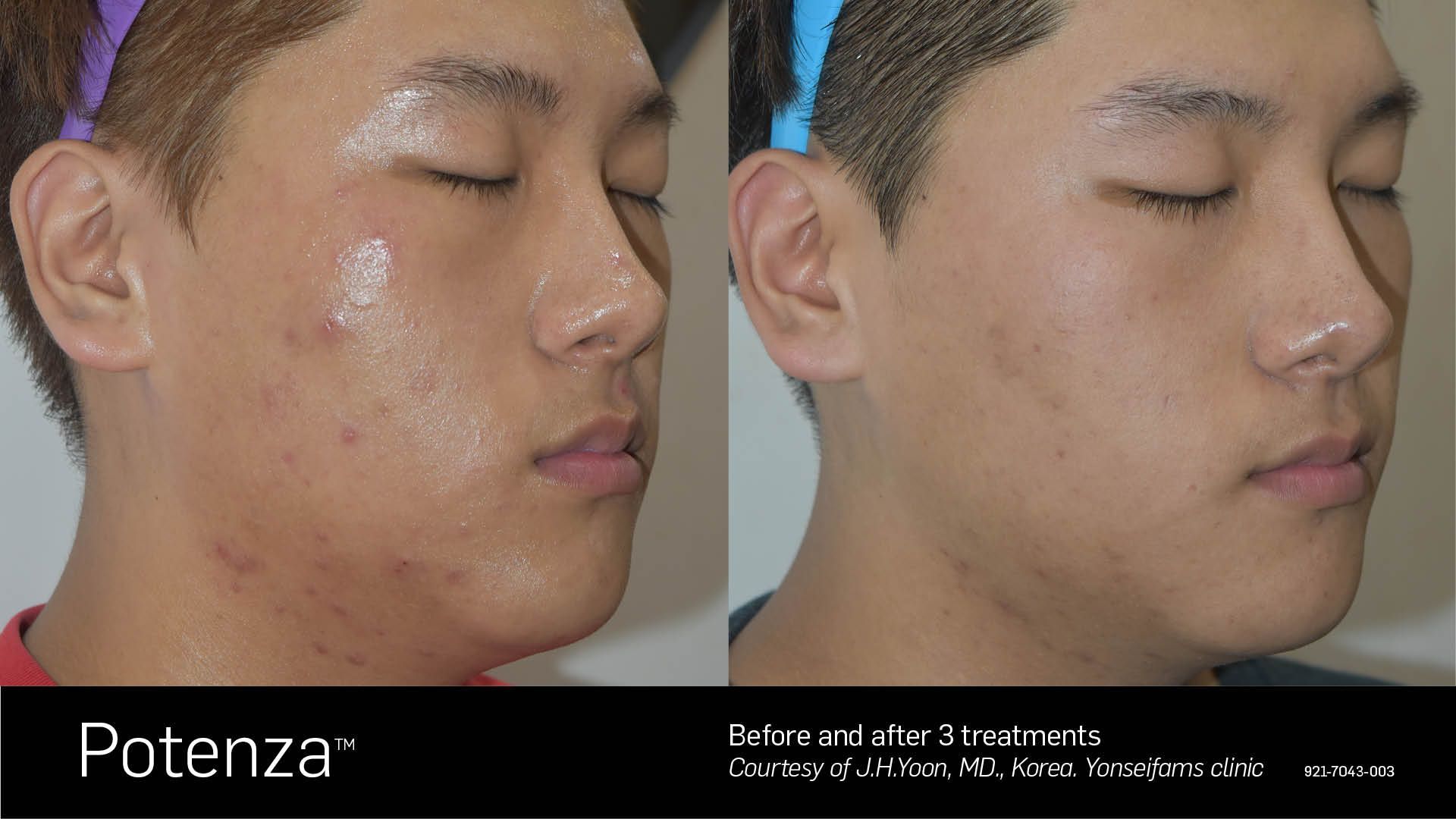 Before and after comparison of a person's facial skin showing reduced acne and texture improvement.