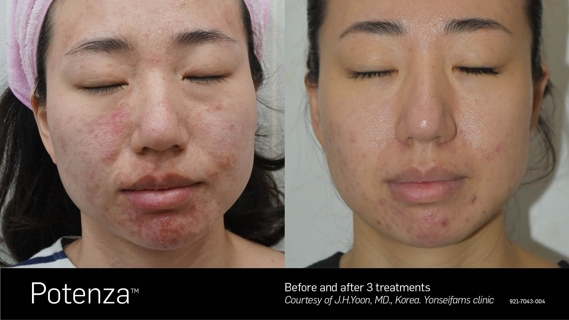 Before and after comparison of facial skin showing reduced acne and redness following two Potenza treatments.