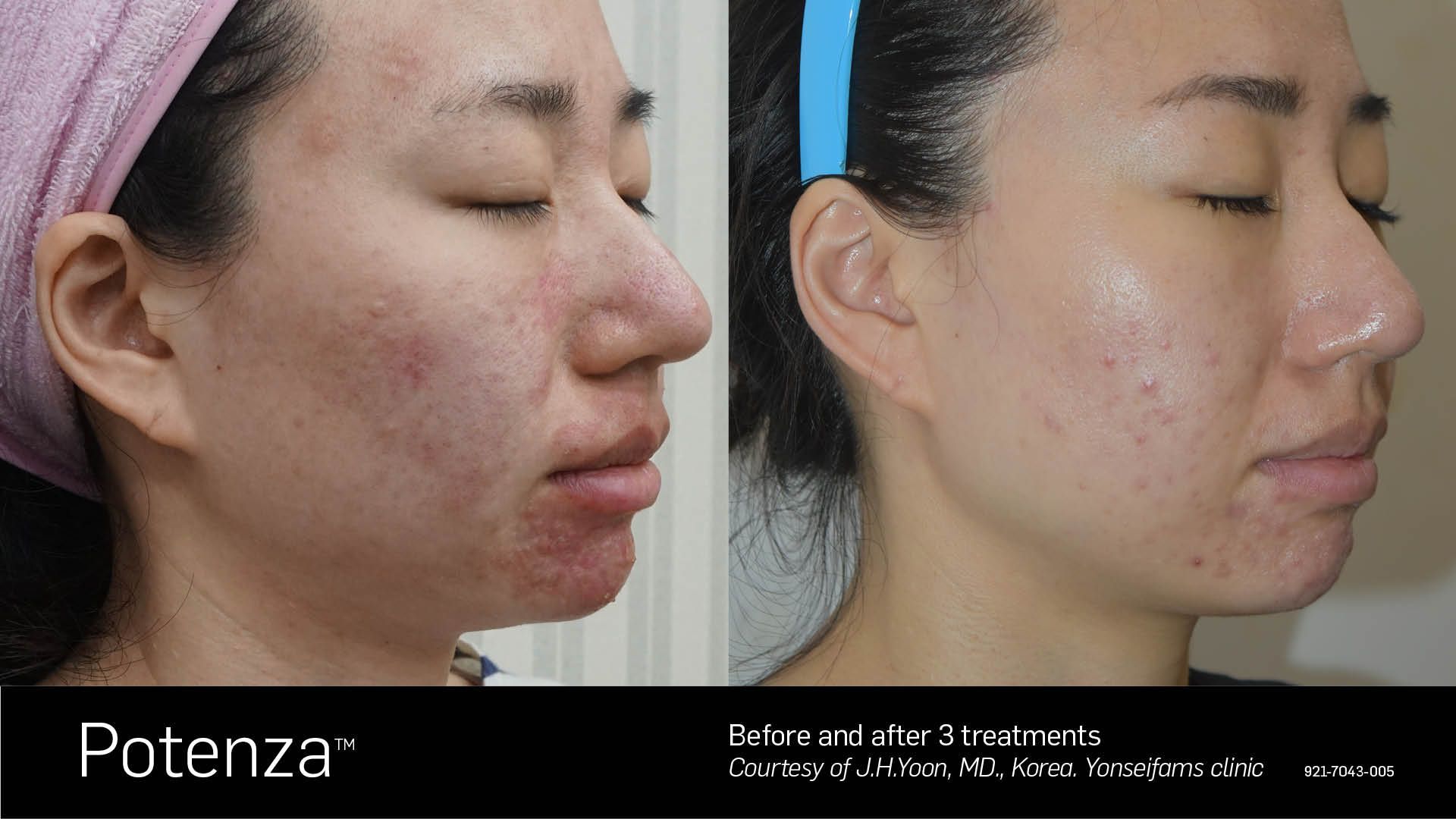 Before and after comparison of a person's skin, showing a reduction in acne and redness after two Potenza treatments.