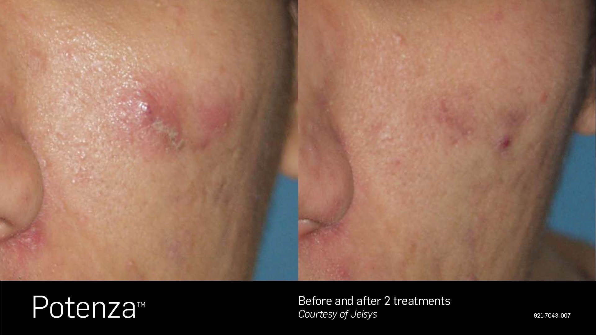 Before and after comparison of a cheek showing reduced acne scarring after two Potenza treatments.