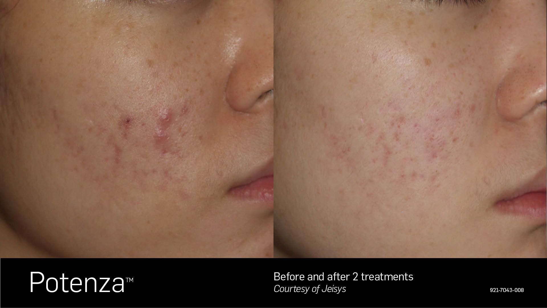 Before and after comparison of a cheek showing reduced acne and skin inflammation following two Potenza treatments.