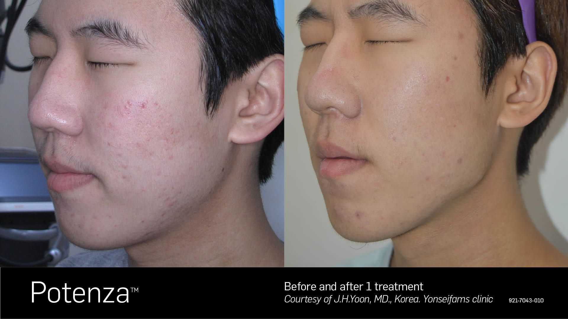 Before and after comparison of a face showing reduced acne scarring after one Potenza treatment.