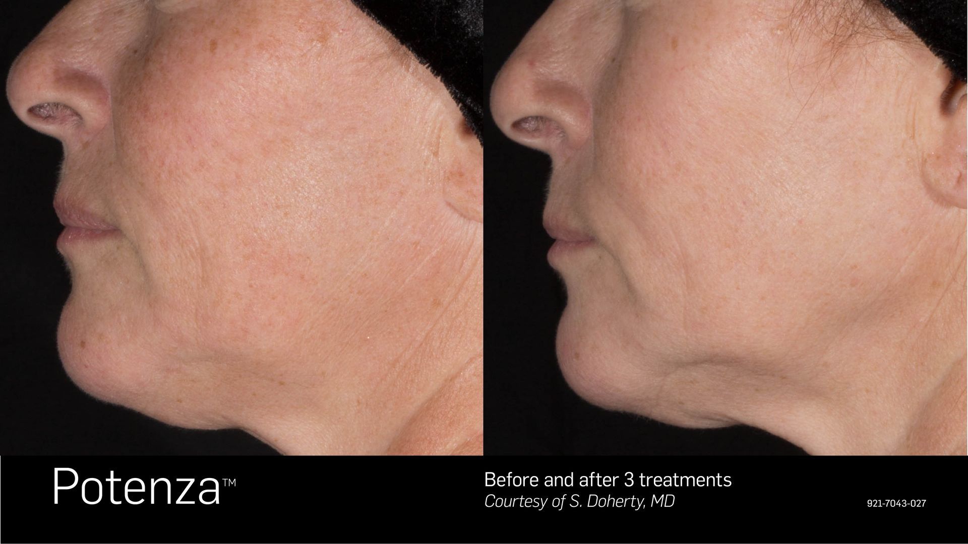 Side-by-side comparison showing improvement in skin texture and jawline definition after three Potenza treatments.