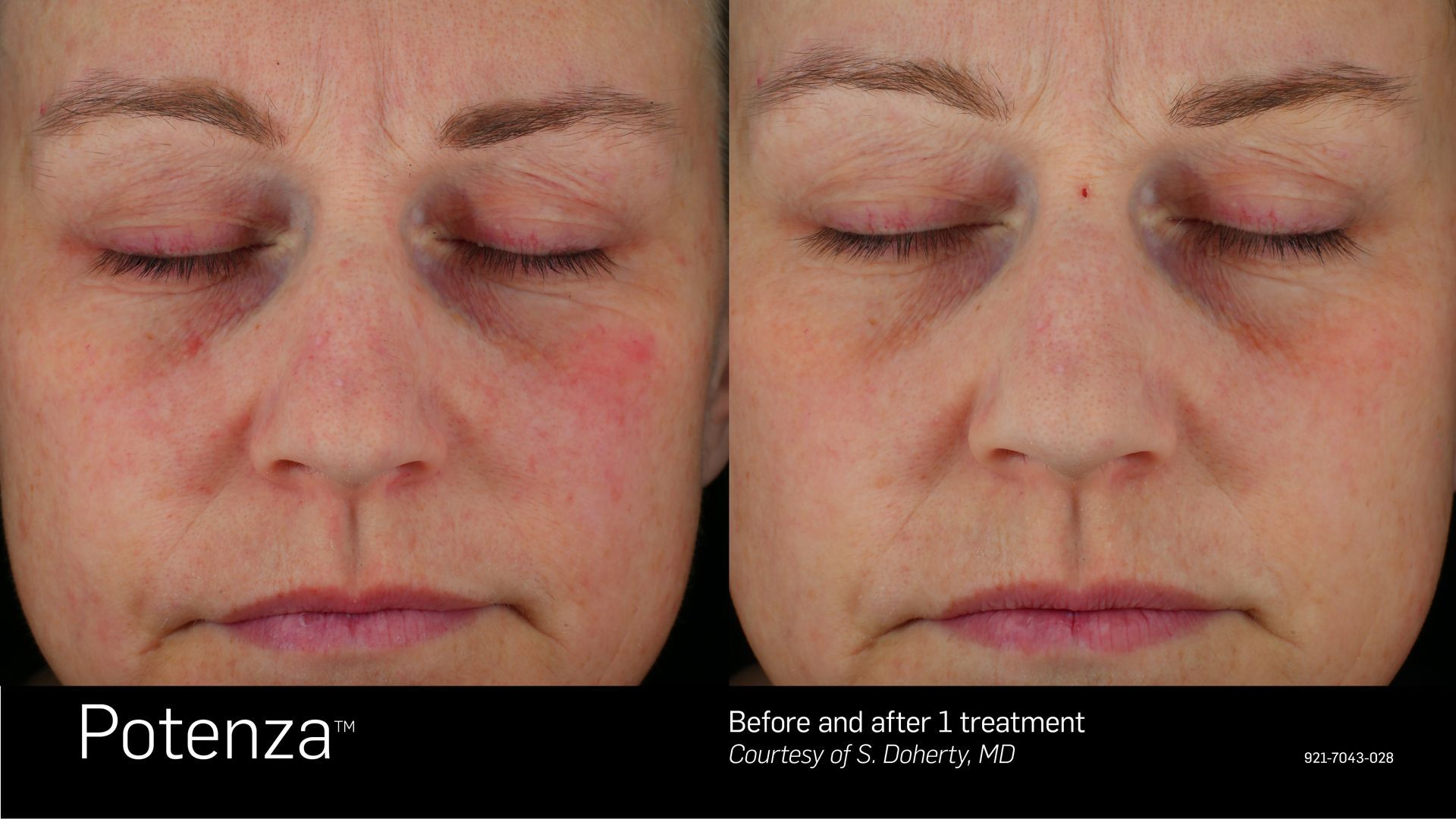 Before-and-after comparison of a face showing skin texture improvement after one Potenza cosmetic treatment.