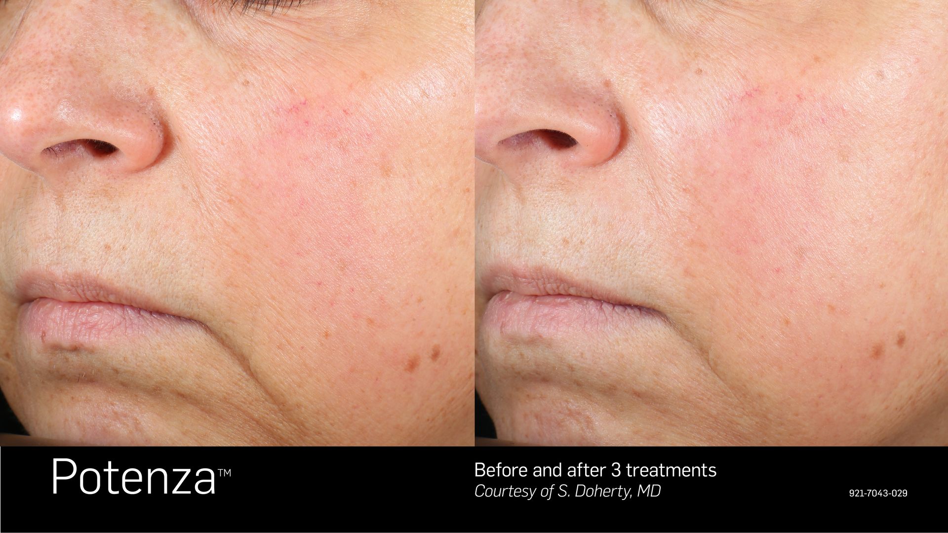 Before-and-after comparison showing facial skin improvement after three sessions of Potenza microneedling treatment.