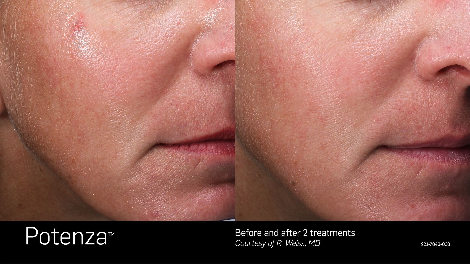 Before-and-after comparison of a facial scar reduction treatment using Potenza technology.