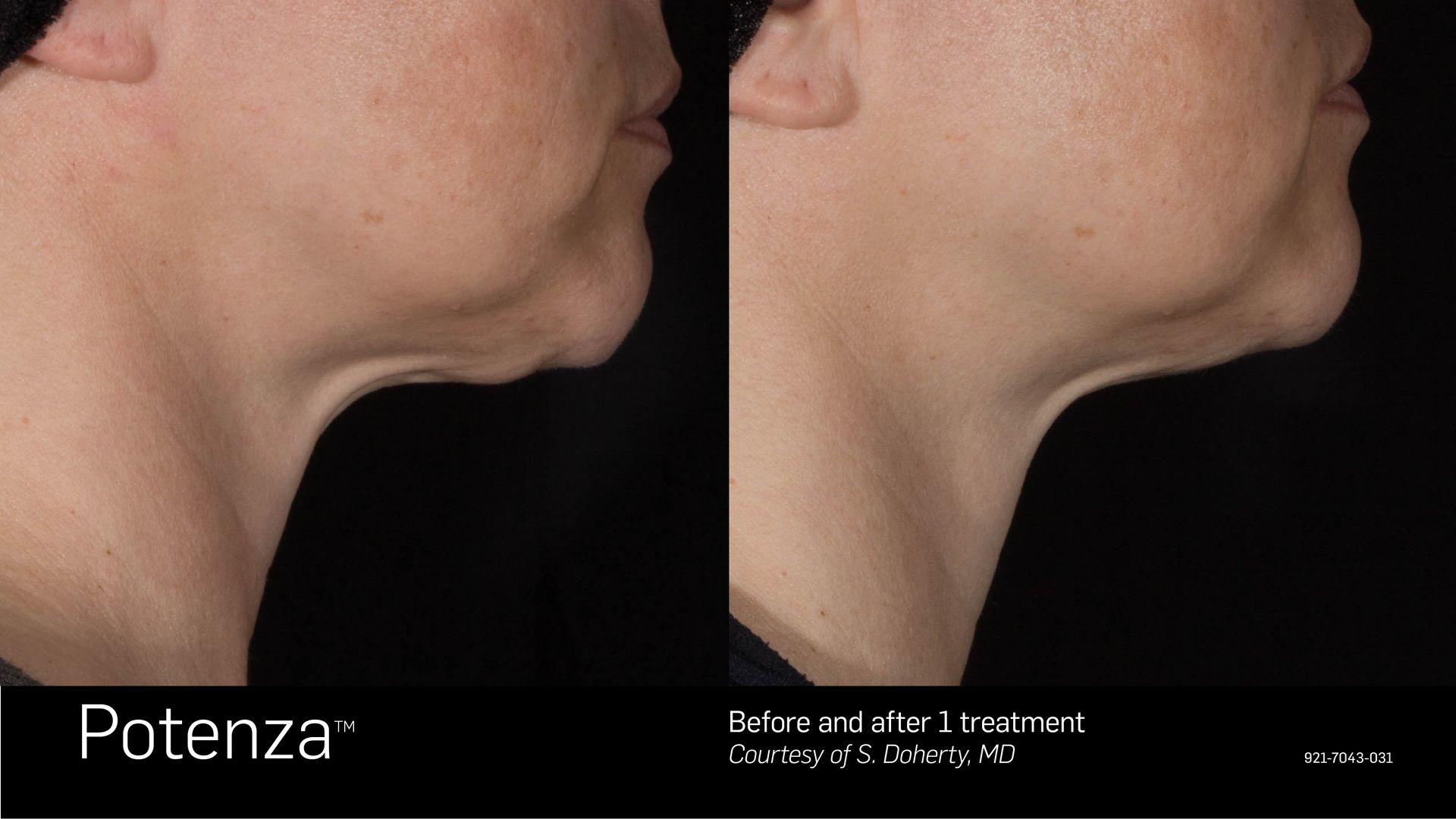 Before-and-after profile view showing a reduction in chin and jawline sagging following a Potenza aesthetic treatment.