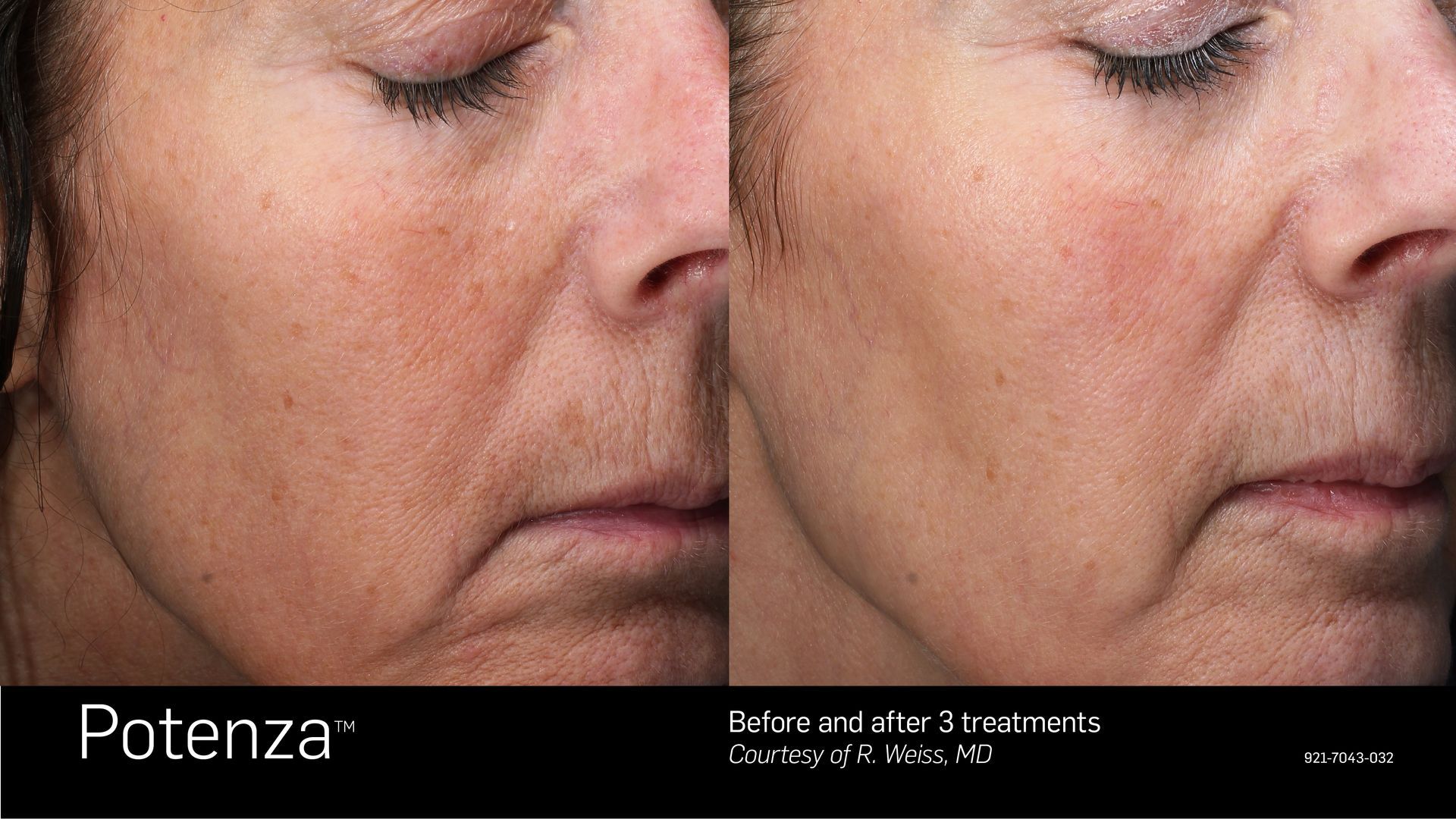Before and after comparison of skin texture improvements on a cheek and mouth area following Potenza microneedling.