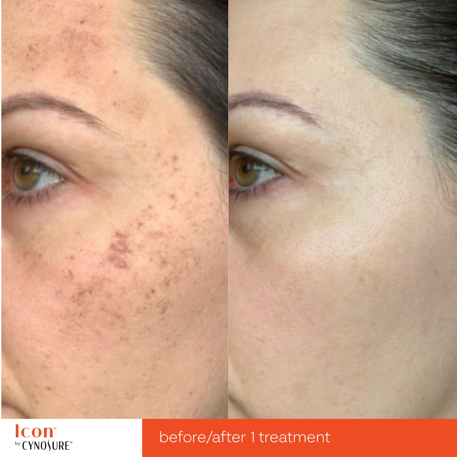 Before and after comparison of a facial skin treatment, showing a significant reduction in dark, patchy pigmentation.
