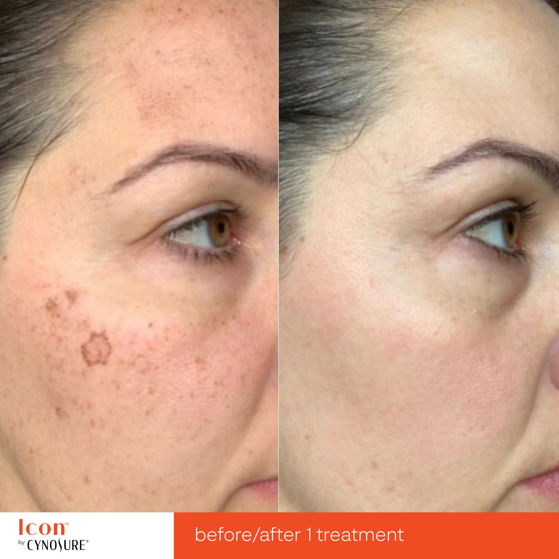Before-and-after comparison of a face showing skin pigmentation reduction after one laser treatment.
