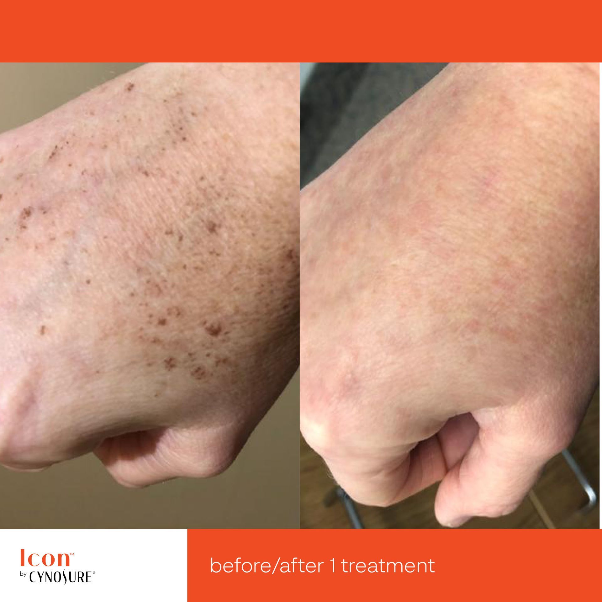 Before and after comparison of a hand showing skin pigment reduction after one laser treatment.