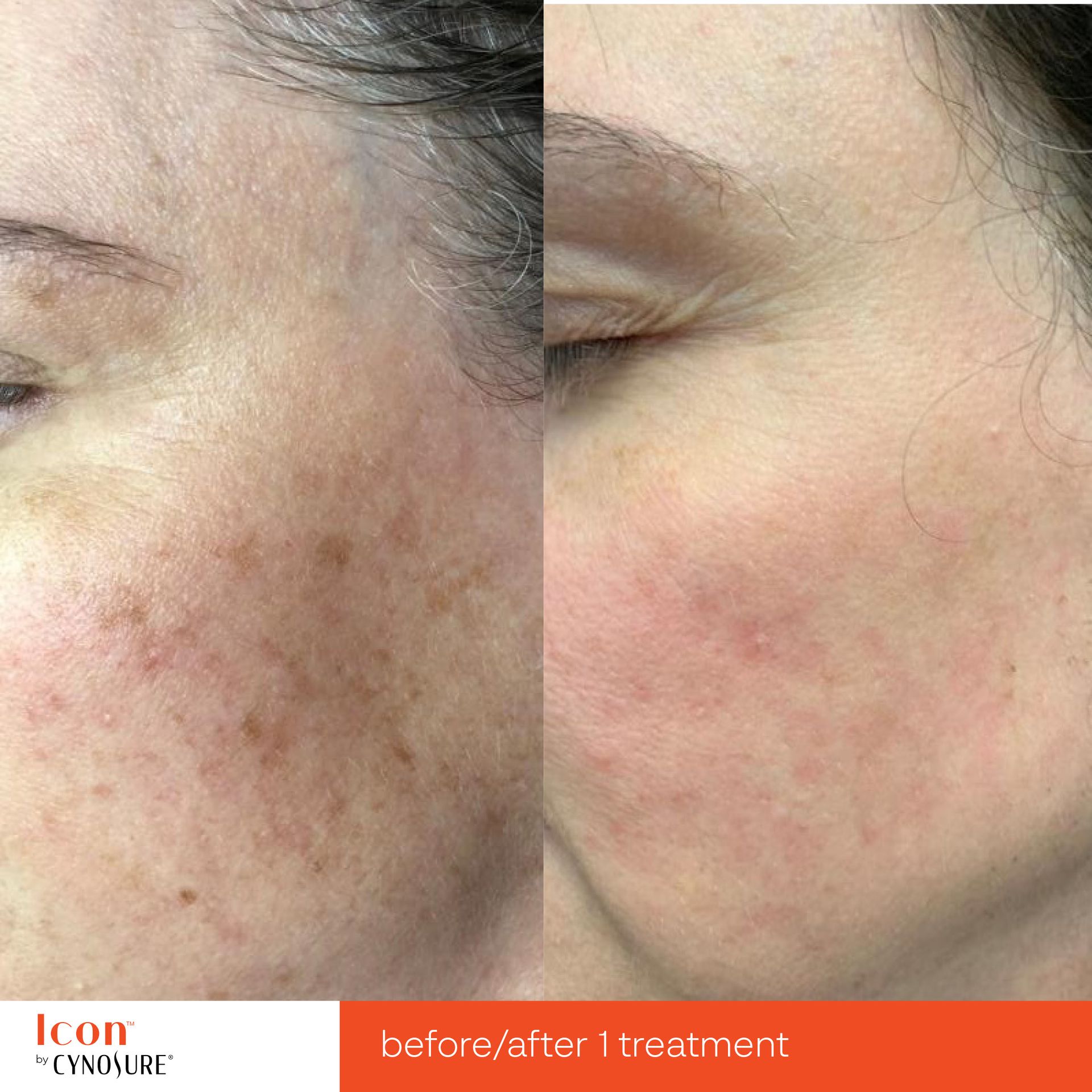 Before and after photo of a skin treatment showing significant reduction in brown sun spots and facial hyperpigmentation.