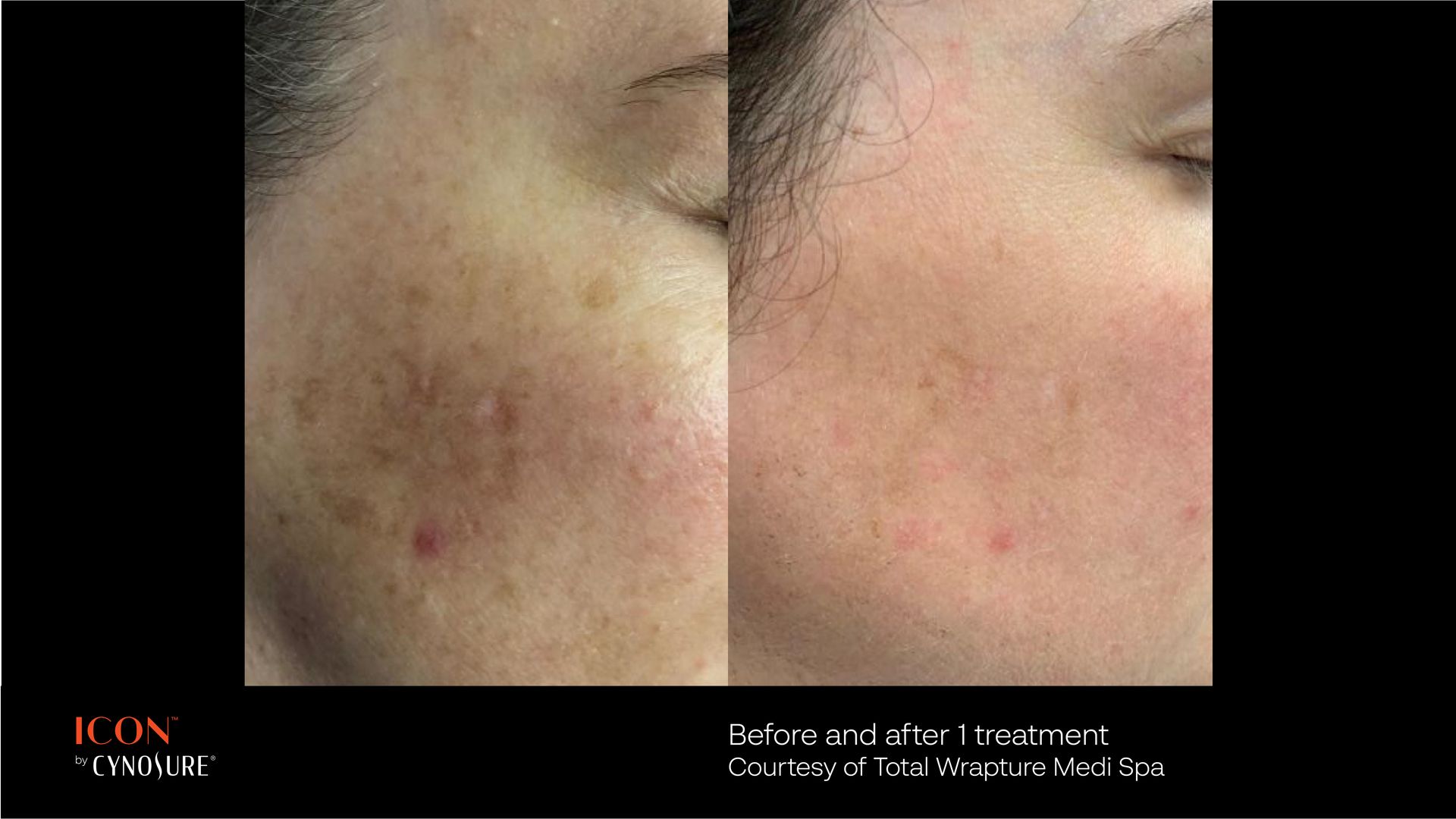Before and after comparison of a cheek showing reduced skin discoloration and pigmentation following laser treatment.