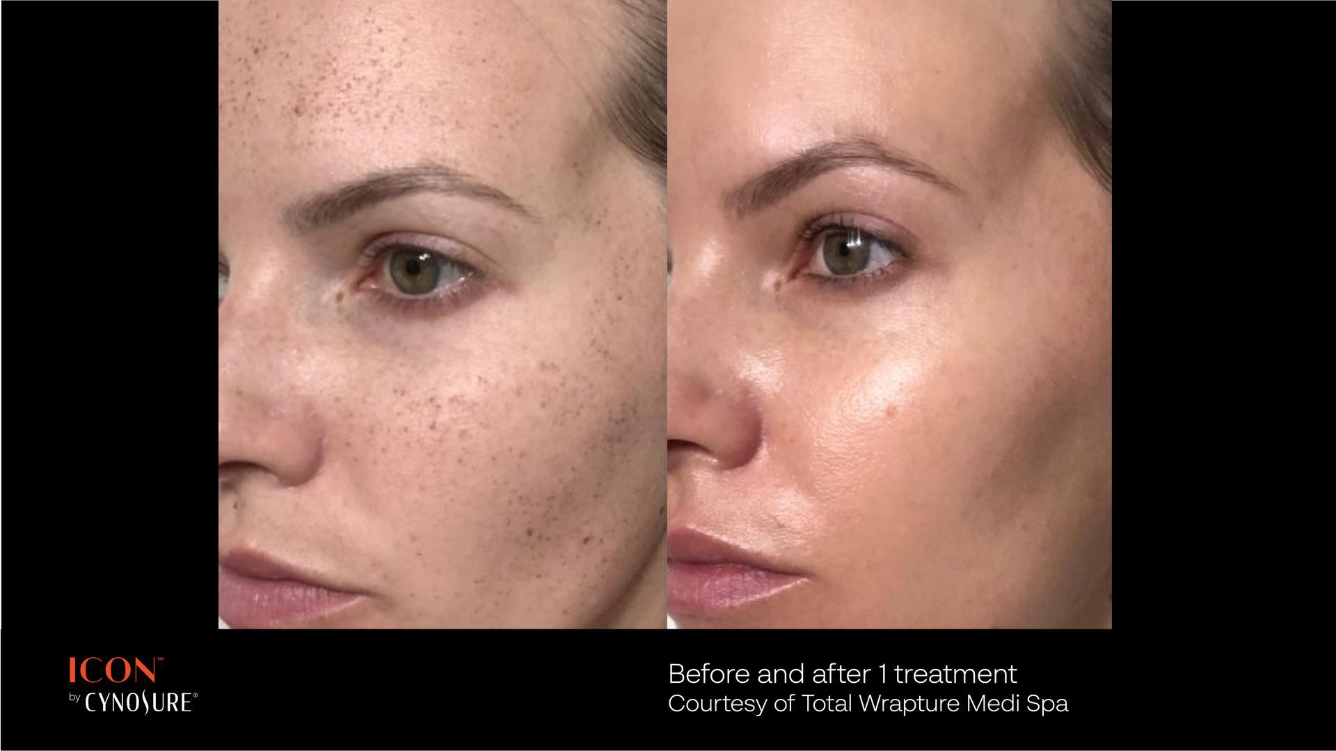 Before and after view of a face, showing improved skin texture and reduced pigmentation following a medical treatment.