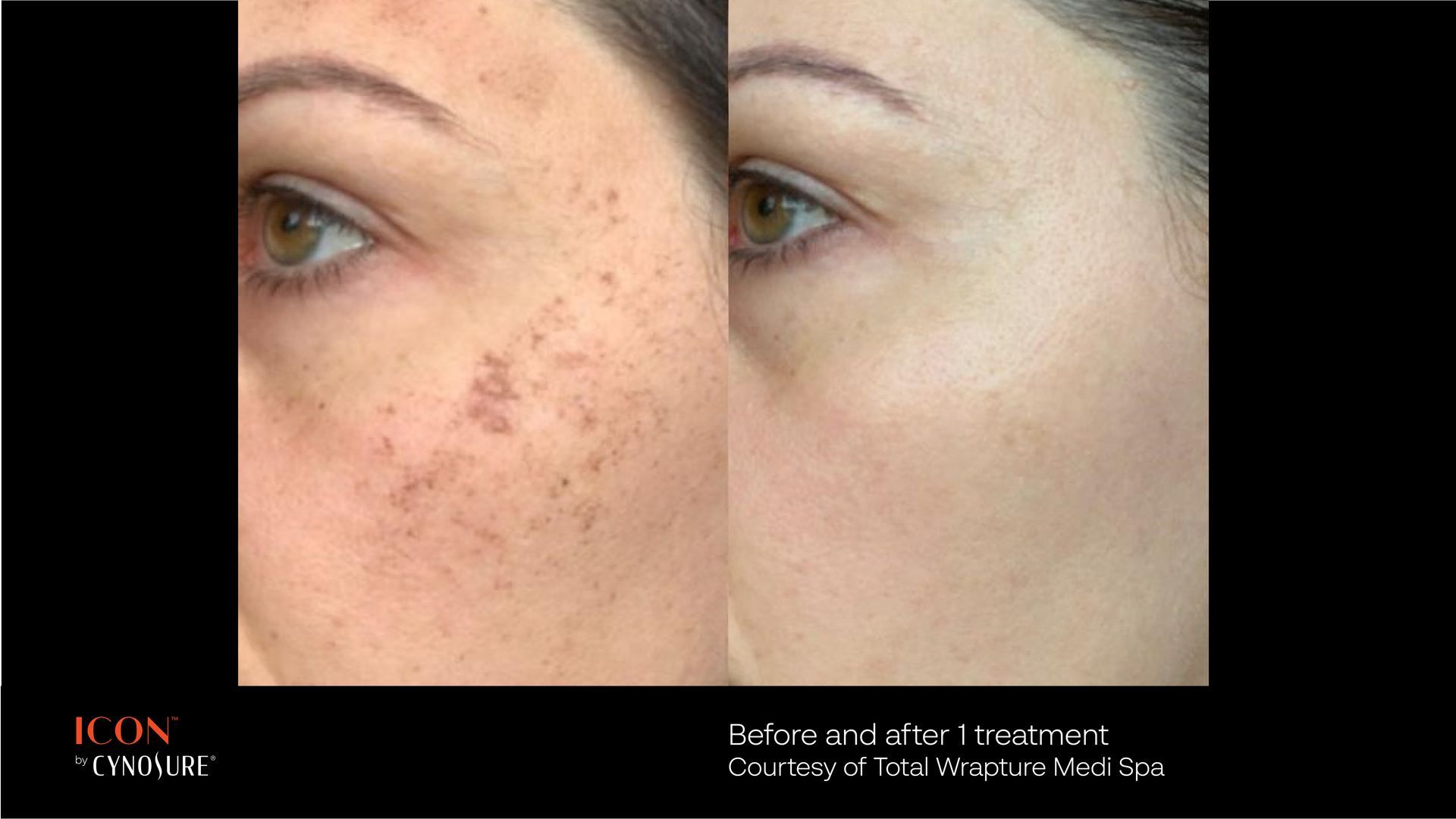 Before-and-after comparison showing the reduction of skin pigmentation spots on a cheek after a laser treatment.
