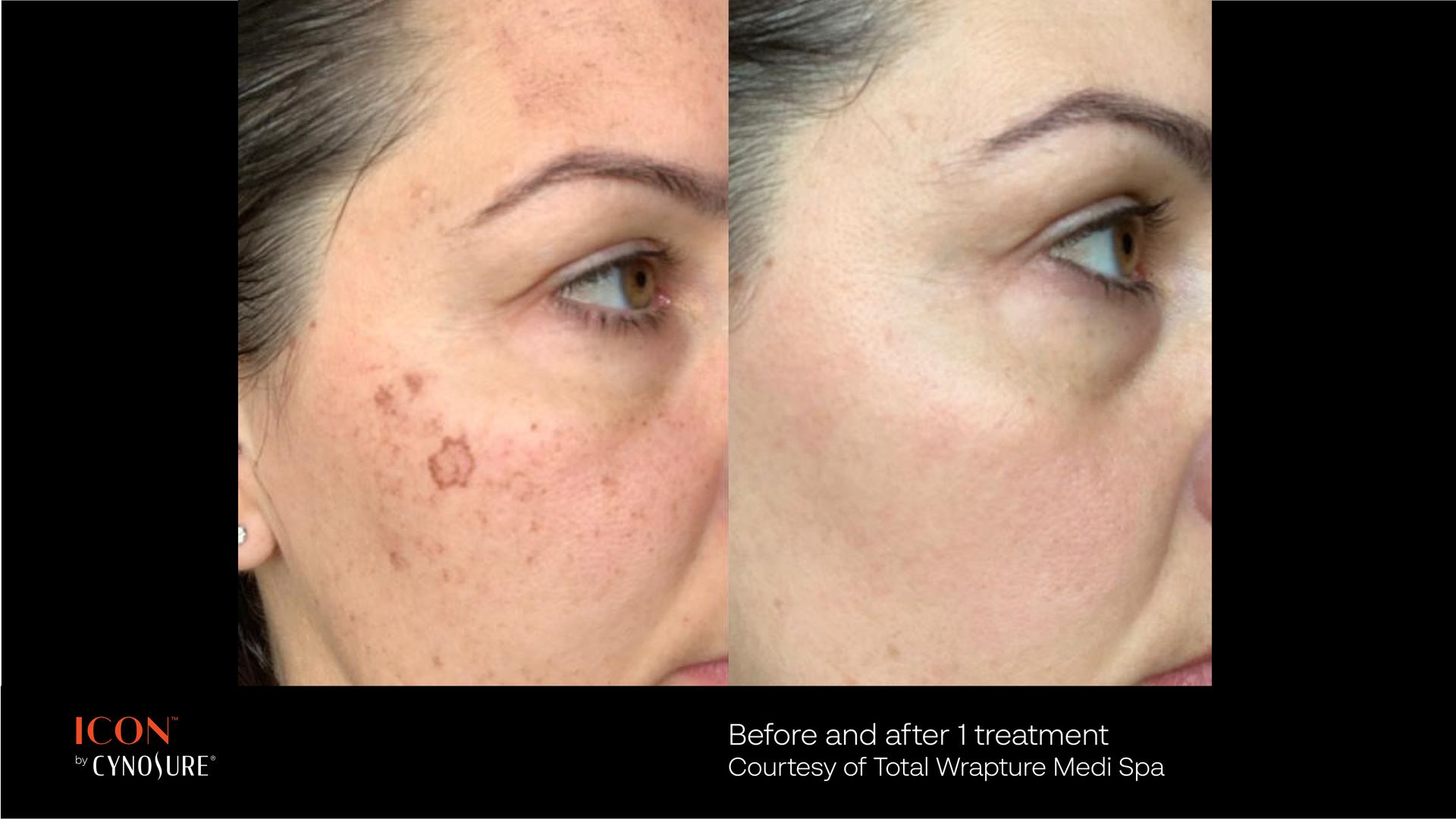 Before and after comparison of a facial skin treatment for hyperpigmentation, showing clearer, more even skin tone.