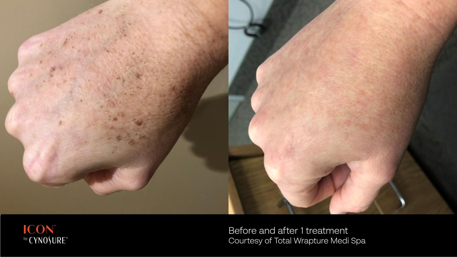 Before and after comparison of a hand showing reduction of sun spots following laser skin treatment.