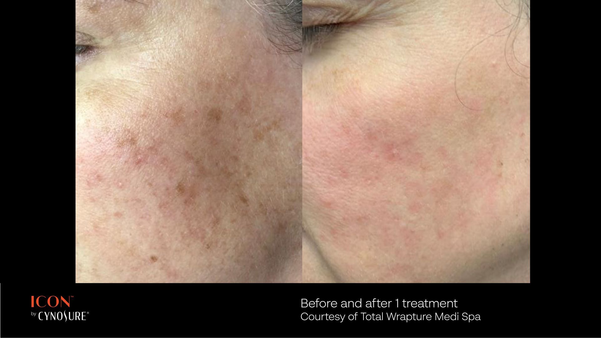 Before and after comparison of skin with brown pigmentation, showing significant clearing after ICON laser treatment.