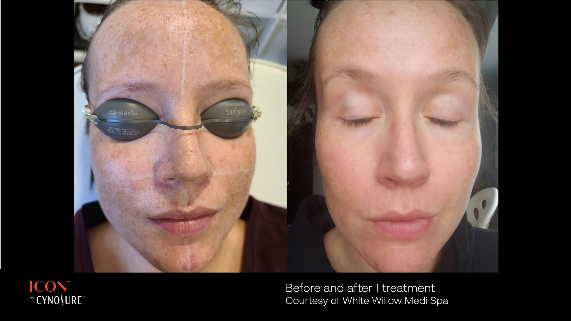 Before and after comparison of facial skin showing reduced pigmentation after laser treatment.