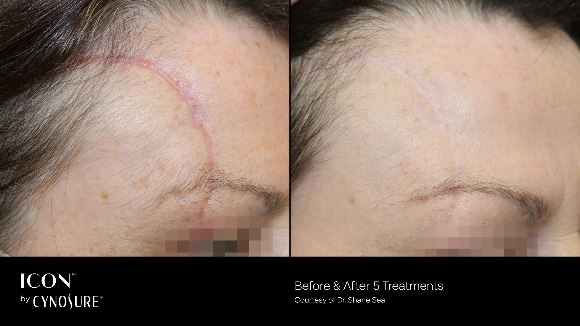 Before and after comparison of a forehead scar treated with laser therapy, showing significant fading after 5 sessions.