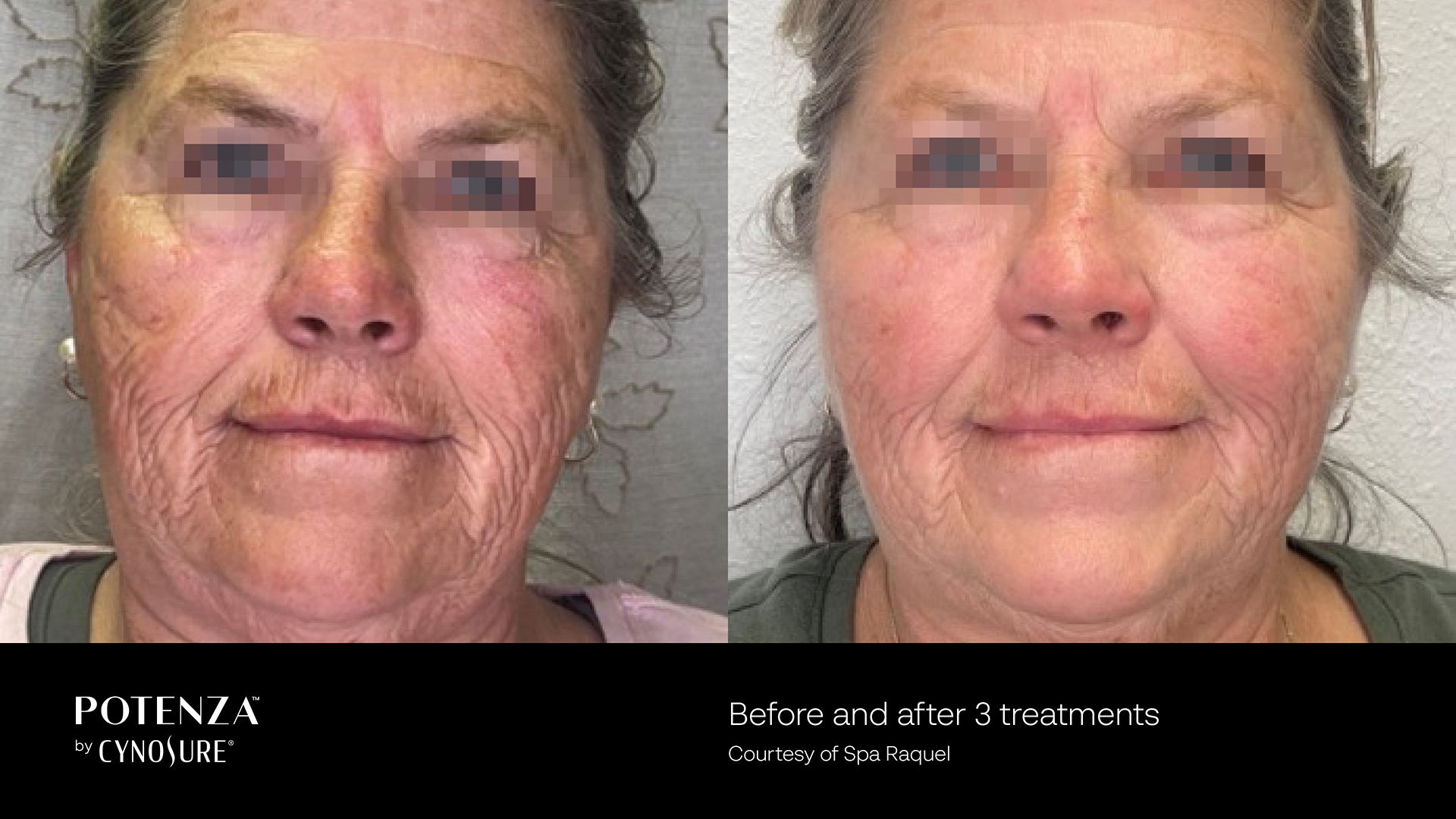 Before and after photos of a person’s face demonstrating skin texture improvement following three Potenza treatments.