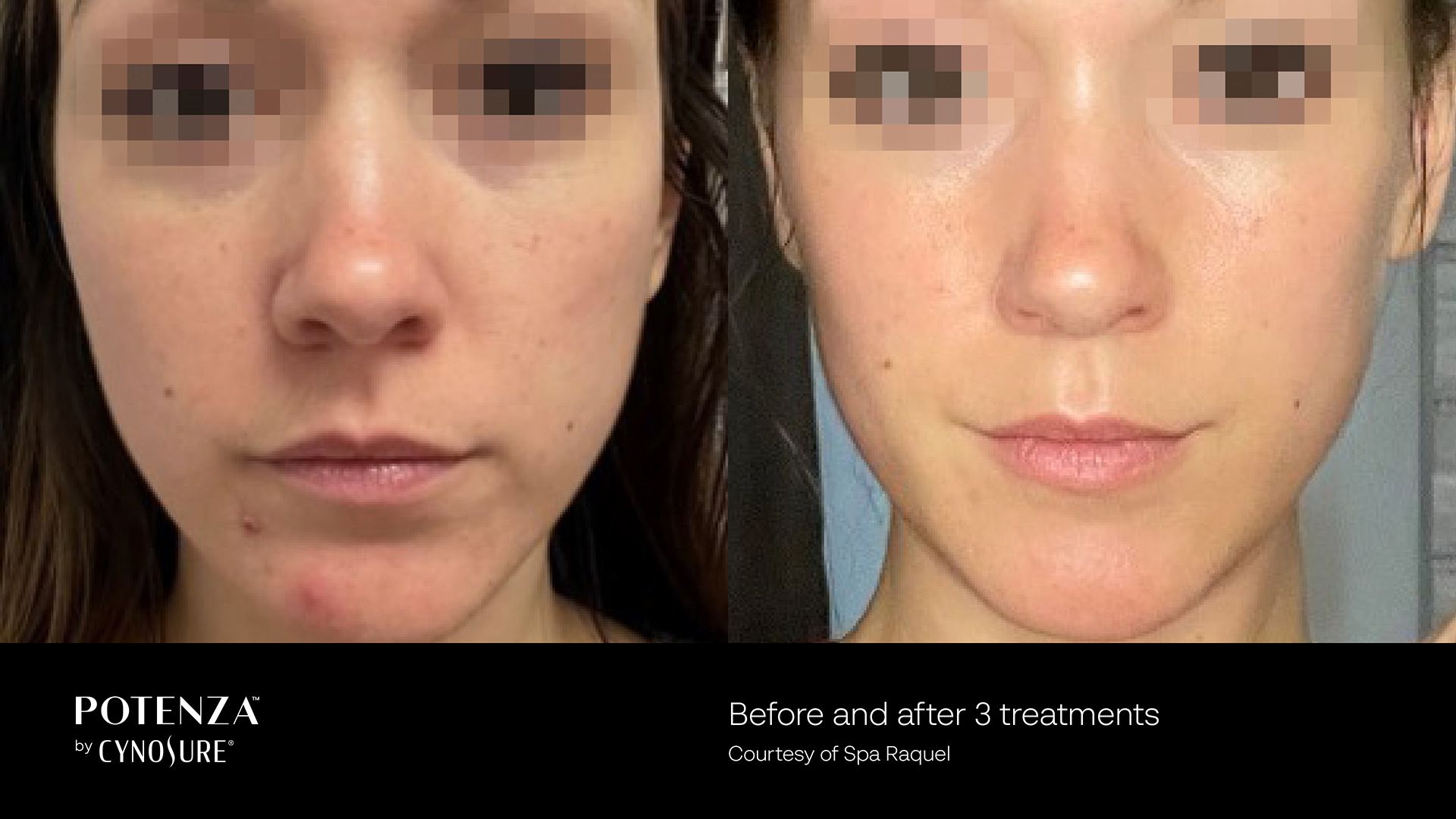 Before and after comparison of facial skin improvement following three Potenza radiofrequency microneedling treatments.