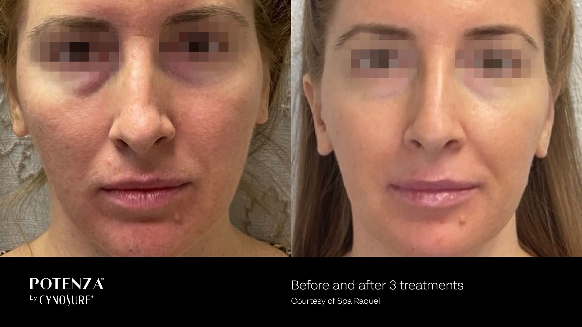 Before and after comparison of a patient’s face after three Potenza microneedling treatments, showing smoother skin.
