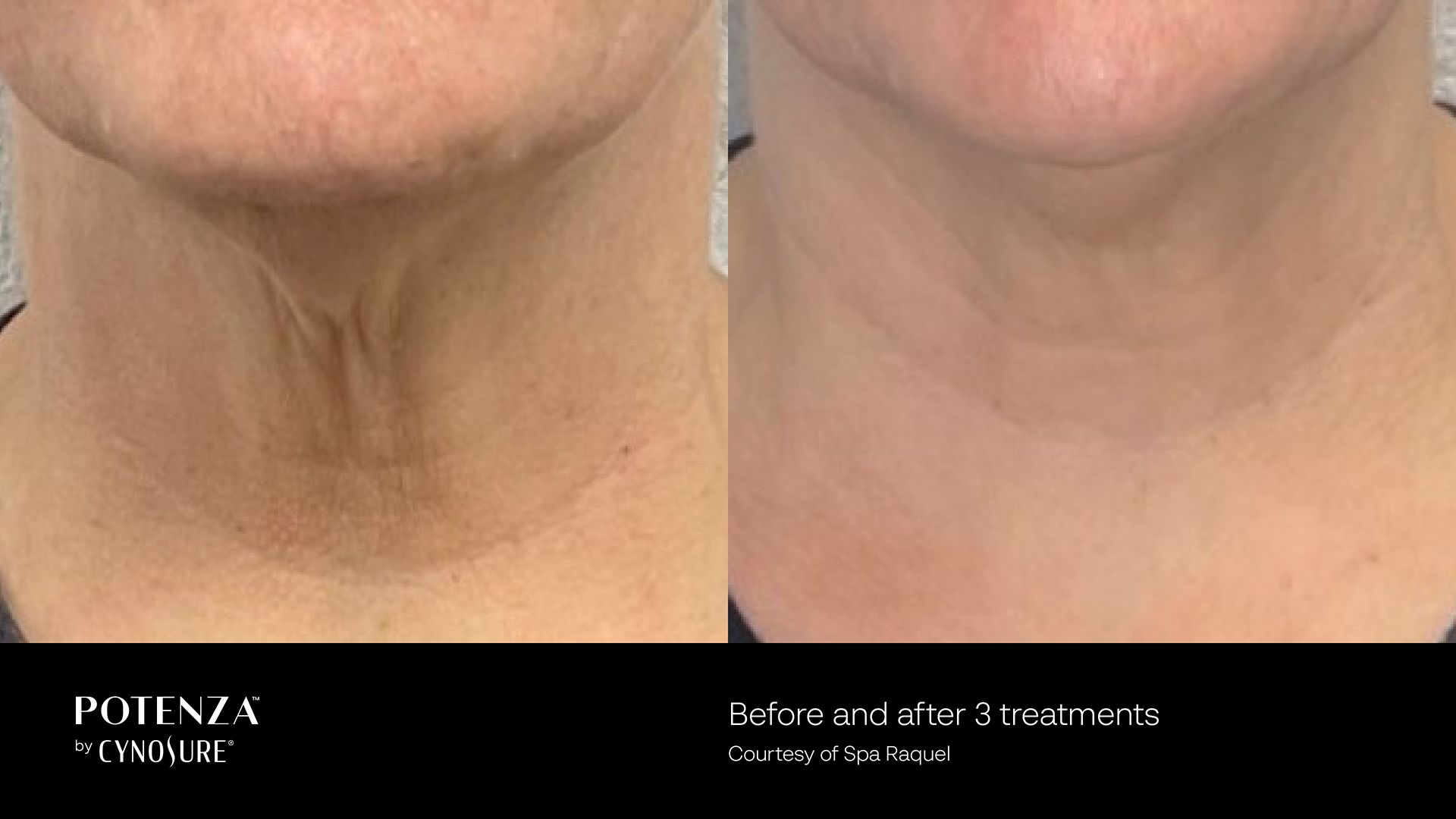 Before and after comparison of a person's neck skin showing improved texture and reduced wrinkles after three treatments.
