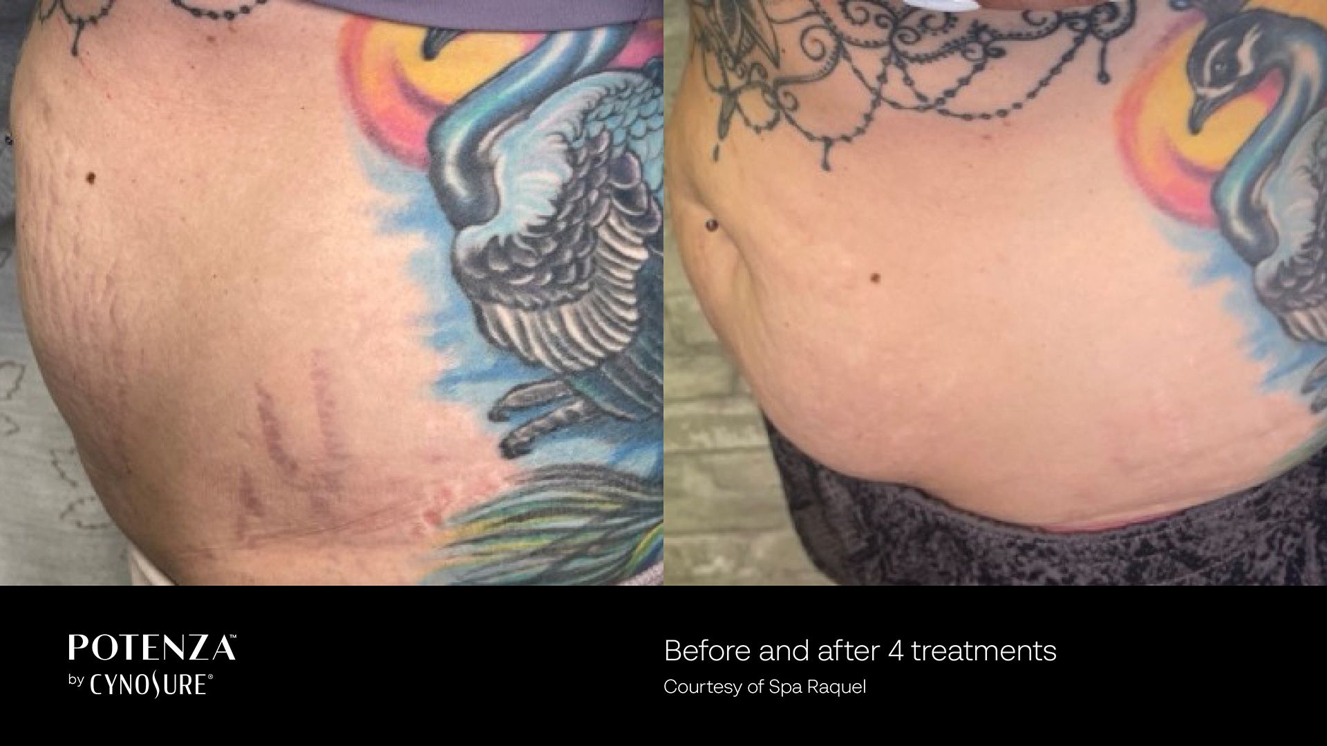 Before and after comparison of skin with stretch marks on a torso, shown after four Potenza radiofrequency treatments.
