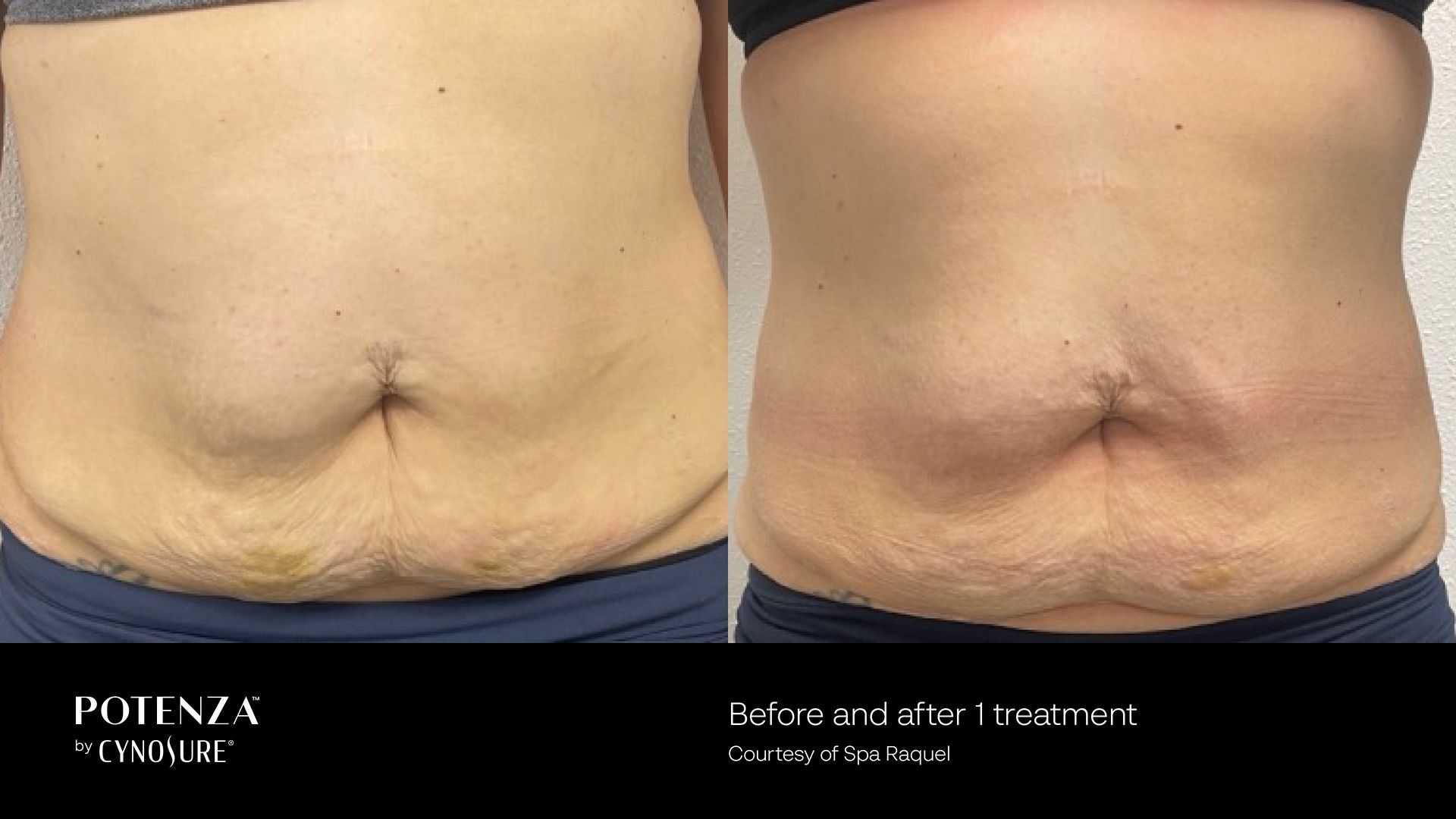 Before-and-after comparison of an abdominal skin tightening treatment showing reduced skin laxity.